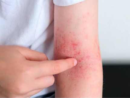 Cuidado com a pele: especialista explica sintomas e tratamento da dermatite atópica