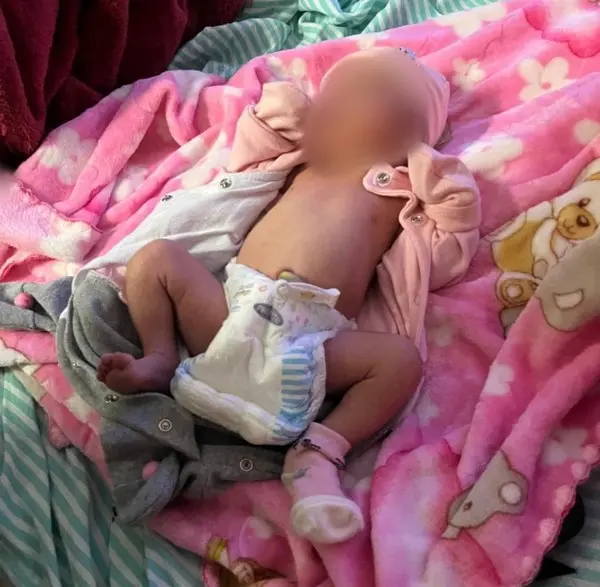Queimaduras não estão descartadas em caso de bebê do Acre, afirmam especialistas em MG