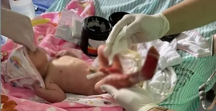 Bebê que pode ter sofrido queimaduras em hospital é levada em UTI aérea para MG
