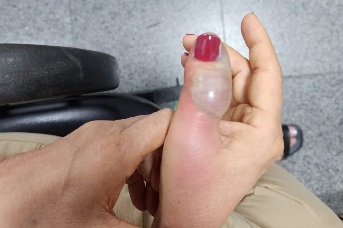 mulher-tem-infeccao-apos-fazer-as-unhas-e-passa-por-4-cirurgias