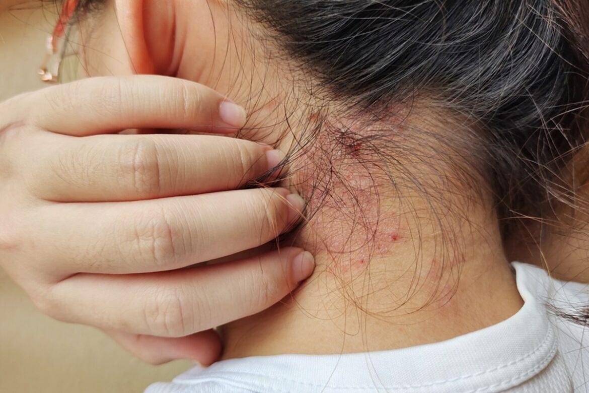 estudo:-alimentacao-pode-influenciar-sintomas-da-psoriase