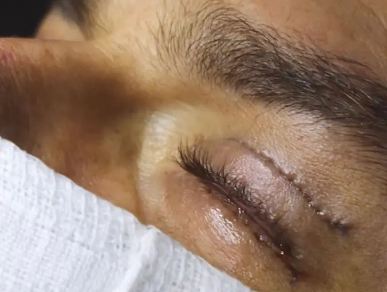 blefaroplastia:-especialista-explica-os-riscos-da-cirurgia-mais-realizada-no-mundo