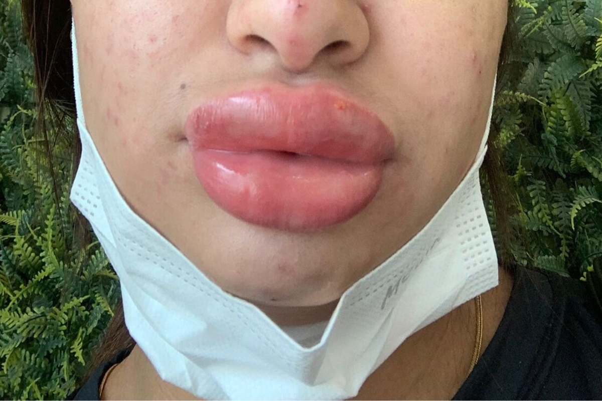 mulher-fica-com-rosto-deformado-apos-procedimento-que-custou-r$-1-mil