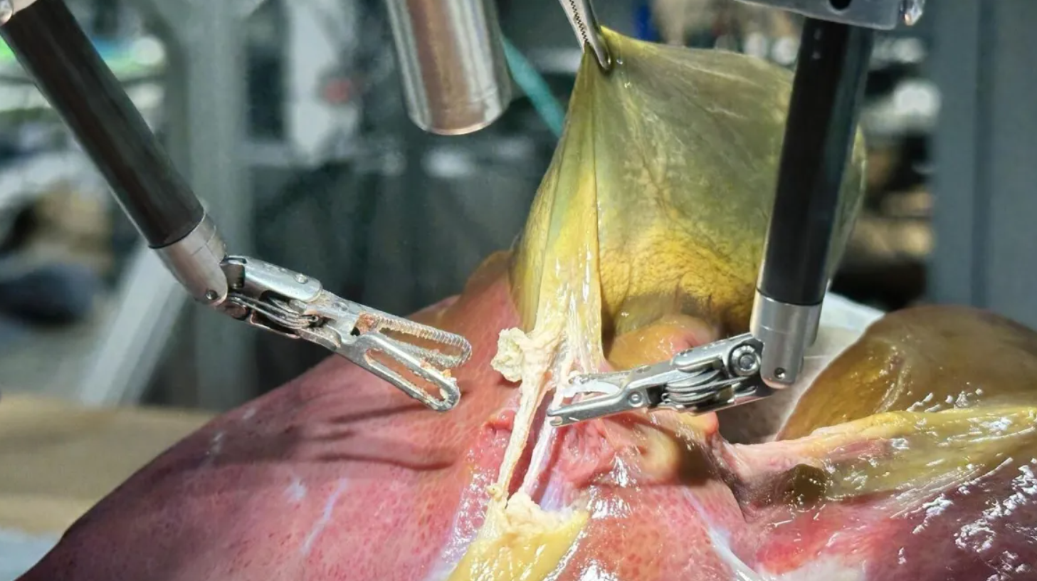 Pela 1ª vez na história, robô faz cirurgia guiado por IA sem ajuda humana