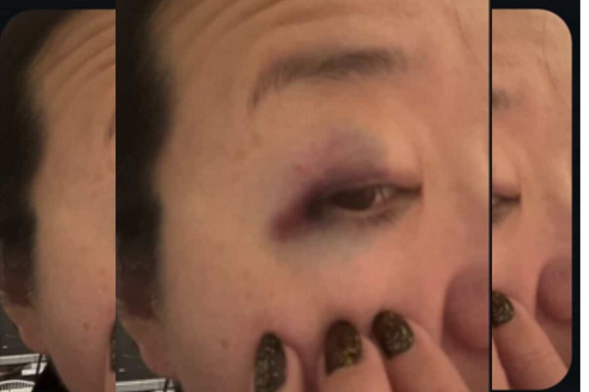 video.-corredora-fica-com-olho-roxo-apos-agressao-no-ibirapuera