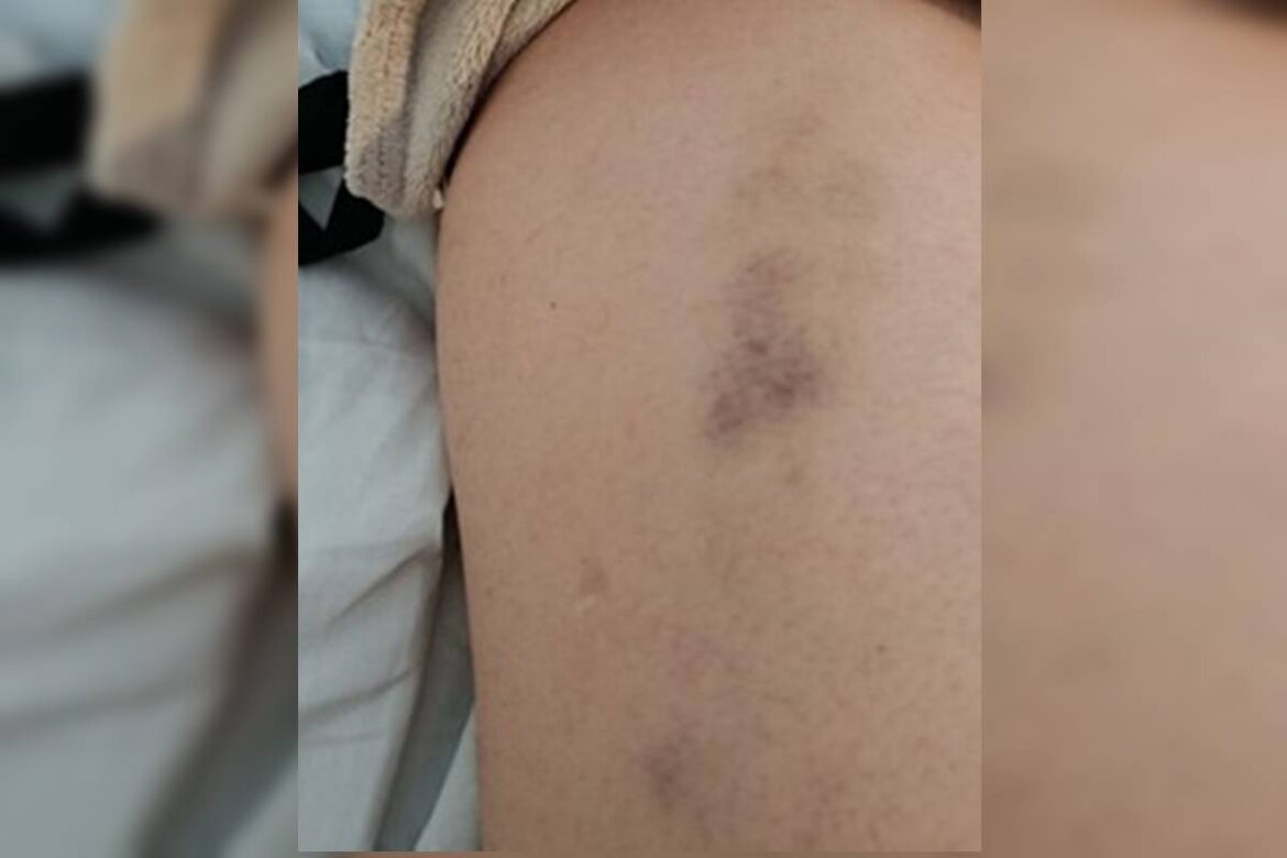 veja-fotos-de-lesoes-em-mulher-espancada-por-empresario-em-elevador