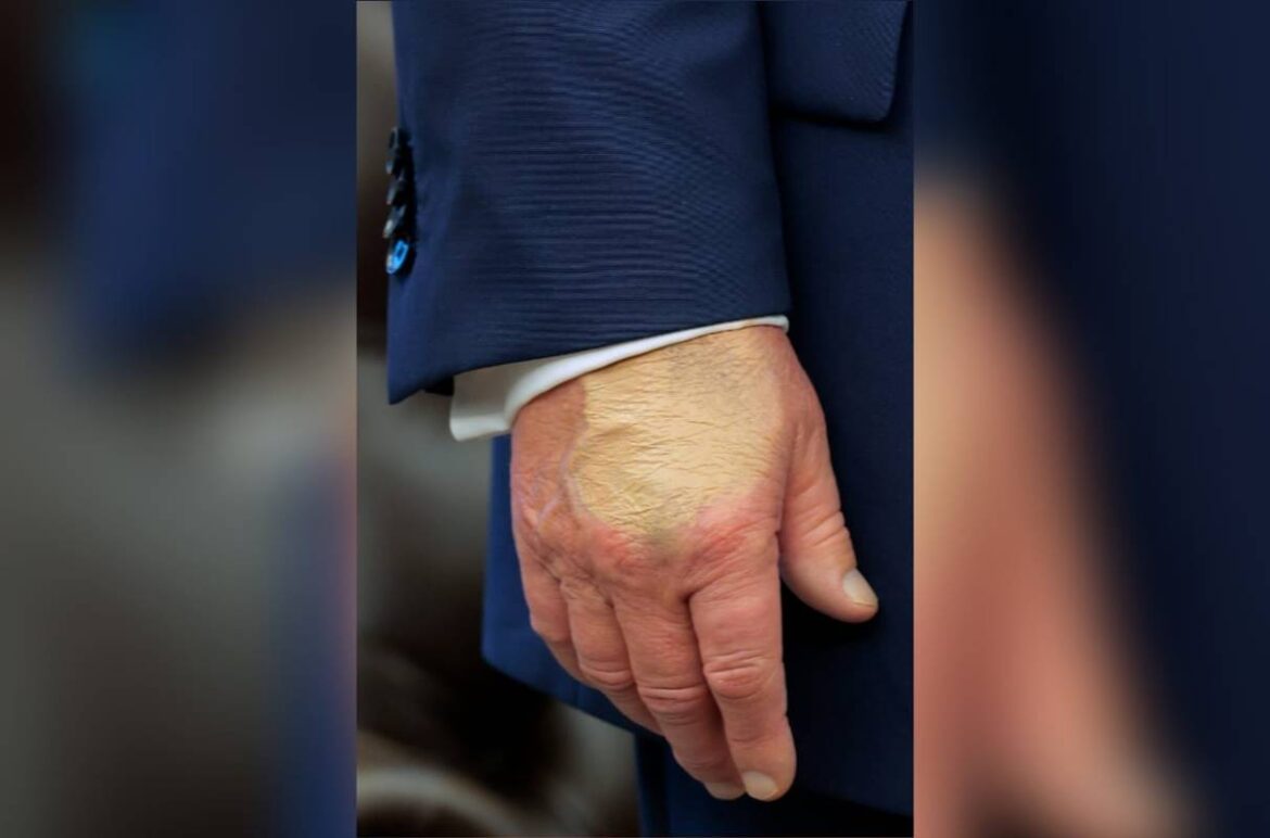 apos-insuficiencia-venosa-cronica,-trump-aparece-com-maquiagem-na-mao