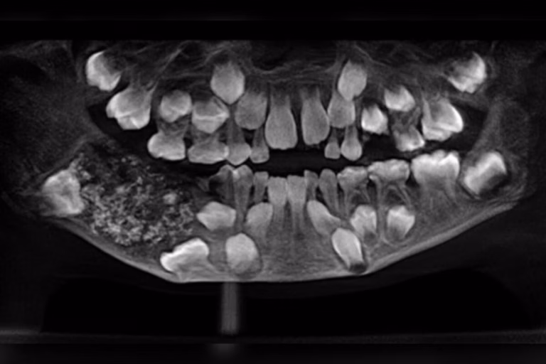 Menino indiano passa por cirurgia e tem 526 dentes retirados da boca