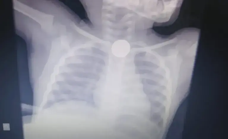 Menino de 2 anos morre após engasgar com moeda de 50 centavos