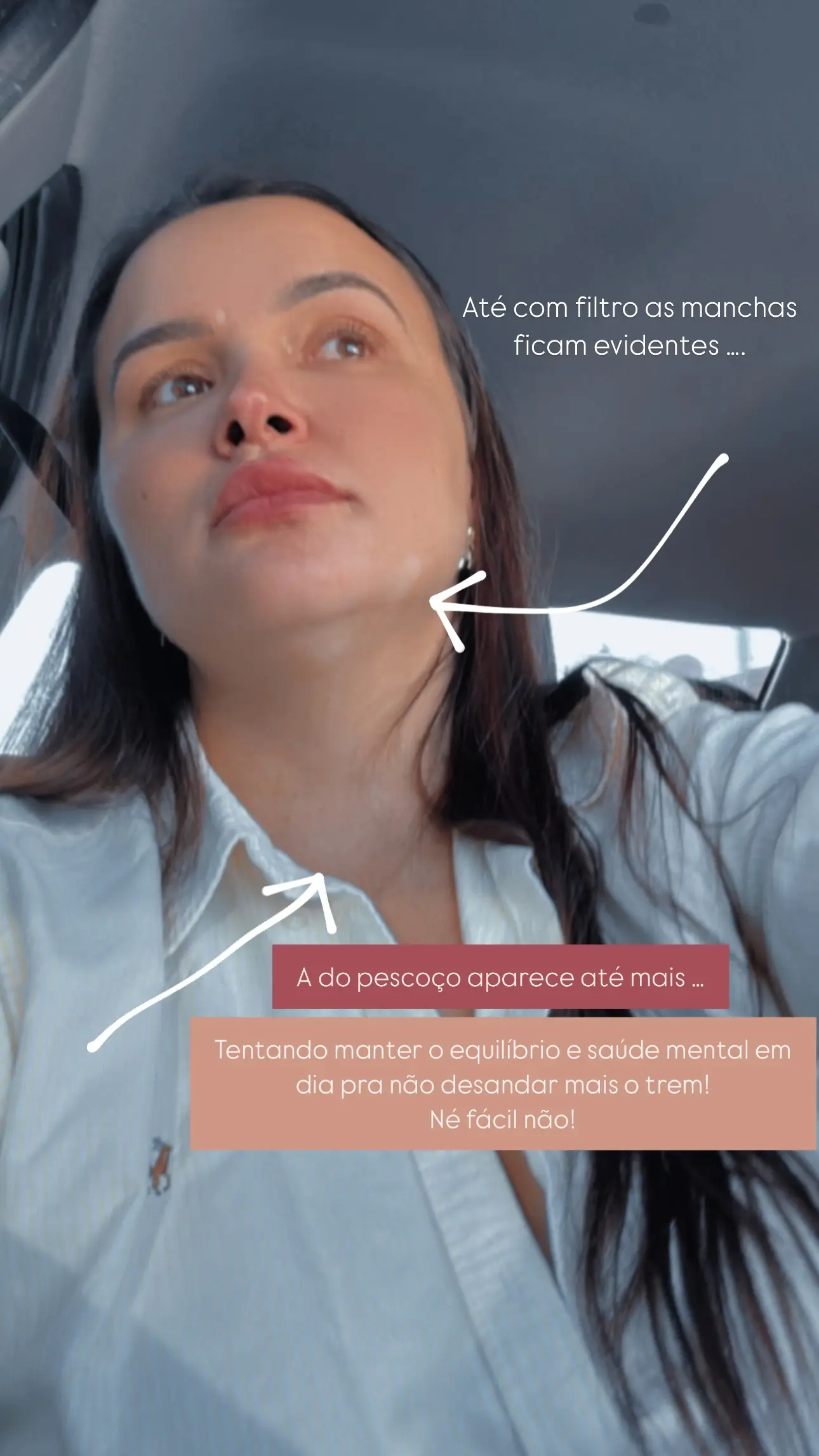 Influenciadora do Acre revela diagnóstico de vitiligo após consulta dermatológica: ‘Né fácil não’