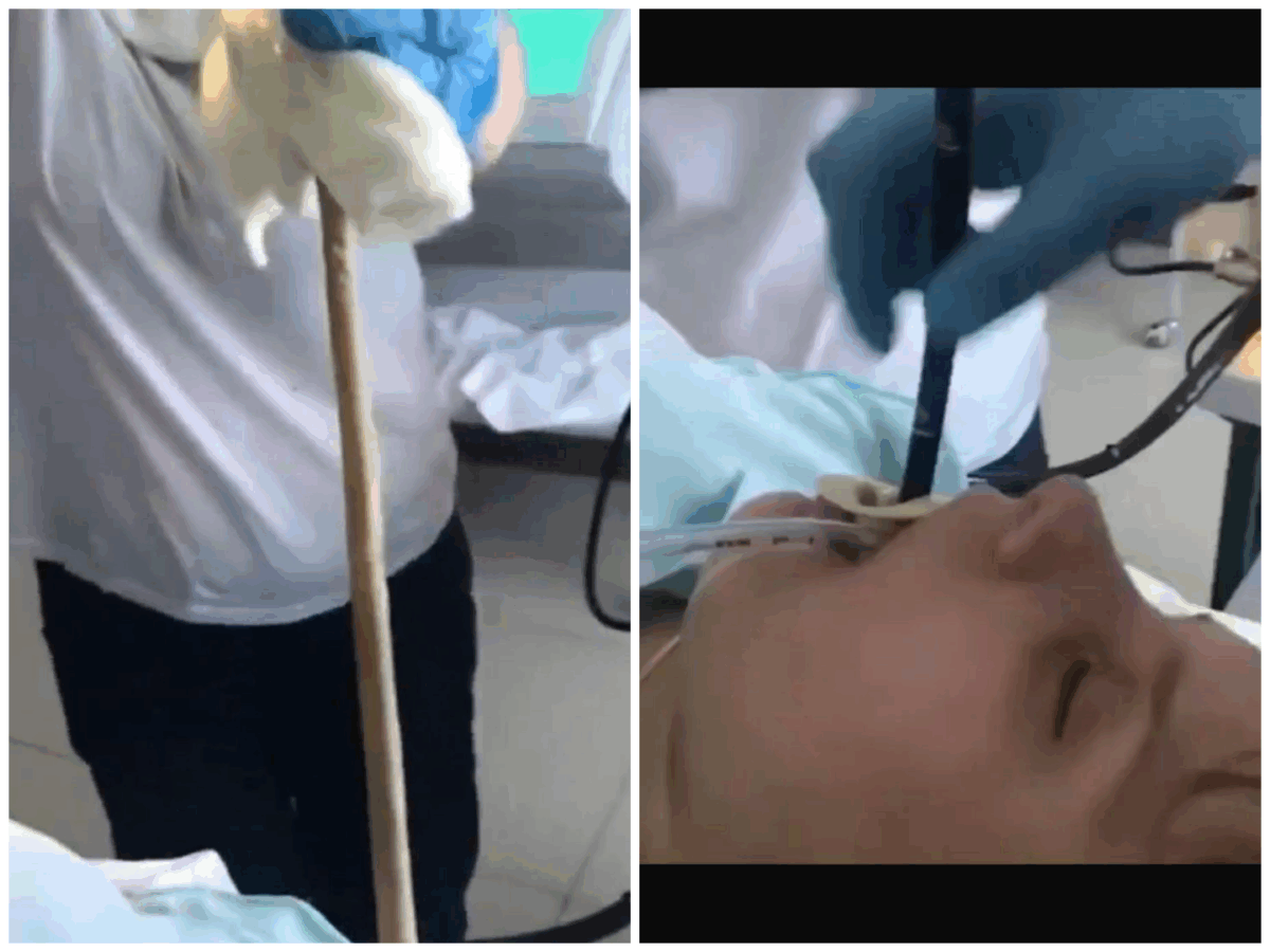 Médicos retiram cobra do estômago de mulher em caso chocante Médicos retiram cobra do estômago de mulher em caso chocante