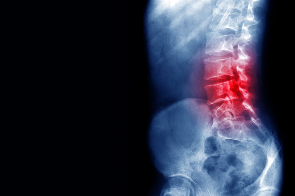 reversao-de-lesao-medular:-tratamento-inedito-tera-teste-clinico-em-sp