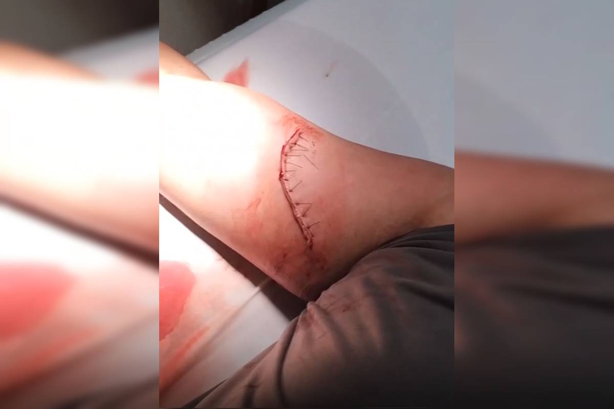 homem-tem-braco-cortado-com-faca-de-30-cm-em-briga-de-rua-no-df