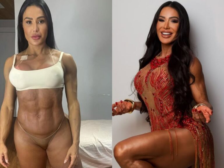 gracyanne-mostra-antes-e-depois-e-explica-ganho-de-20-kg-na-balanca-apos-cirurgia