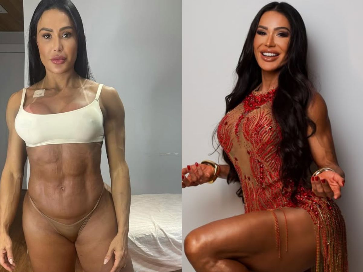 gracyanne-mostra-antes-e-depois-e-explica-ganho-de-20-kg-na-balanca-apos-cirurgia