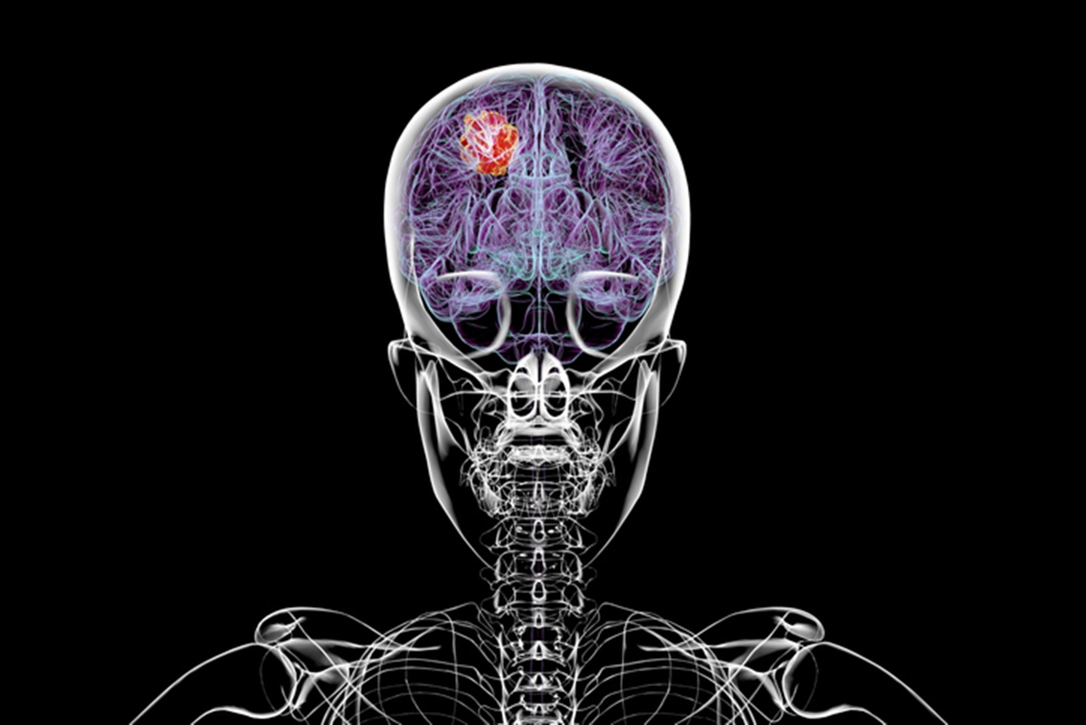 glioblastoma:-cancer-cerebral-grave-corroi-o-cranio,-diz-estudo