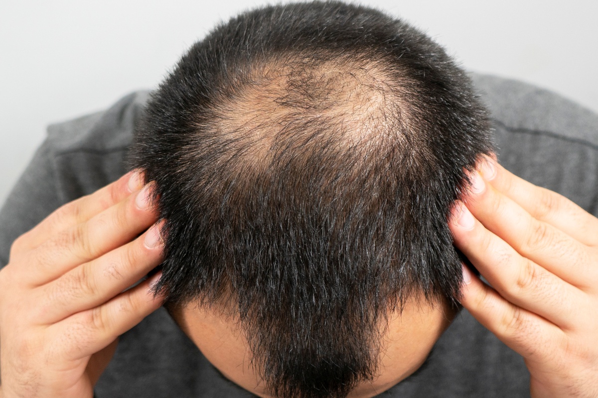 remedio-contra-calvicie-e-ligado-a-maior-risco-de-depressao-e-suicidio