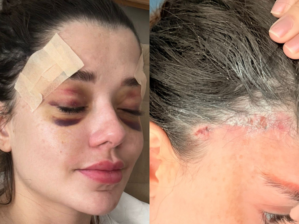 modelo-apresenta-mesmos-sintomas-de-influenciador-que-morreu-e-registra-b.o-contra-dentista