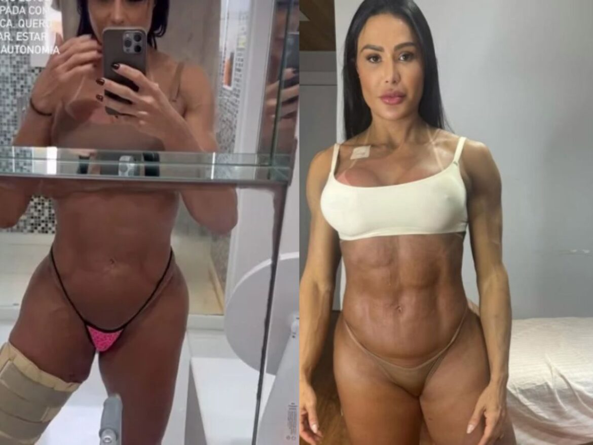 gracyanne-barbosa-fala-sobre-ganho-de-peso-e-exibe-joelho-14-dias-apos-cirurgia