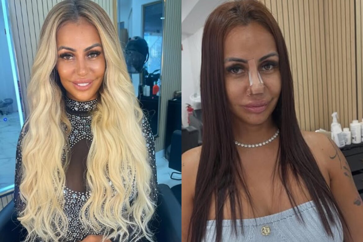 influencer-revela-que-refez-harmonizacao-facial-apos-dica-do-chatgpt