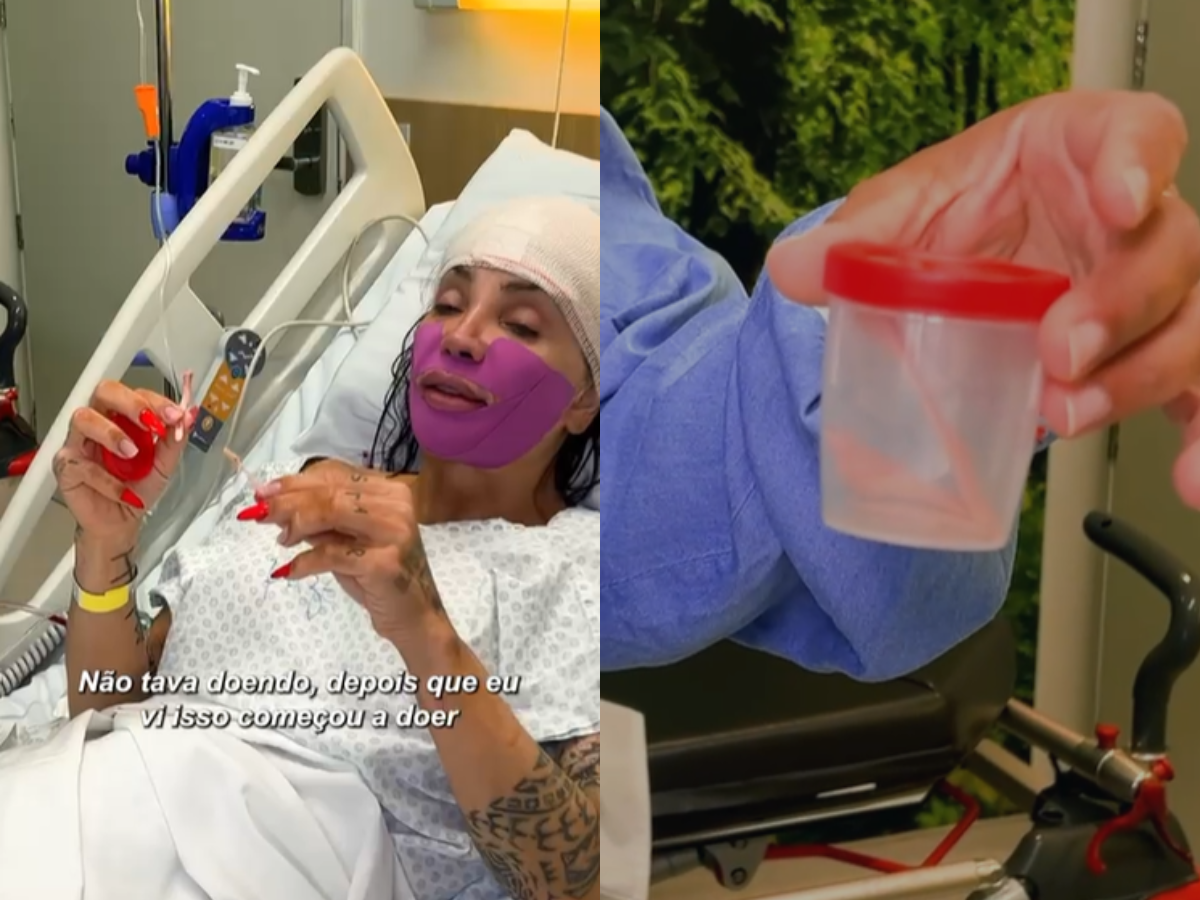 maya-massafera-faz-cirurgia-e-retira-parte-do-maxilar-para-deixar-rosto-“mais-delicado”