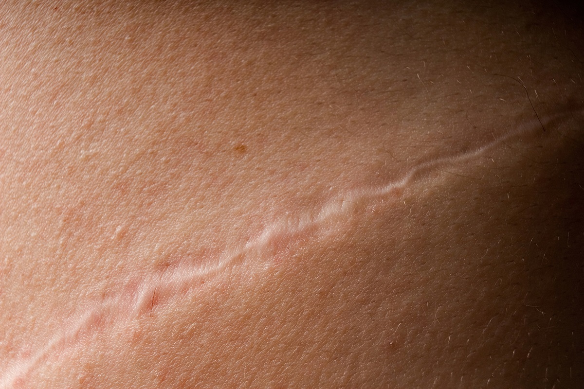 estudo:-proteina-ligada-ao-cancer-ajuda-a-cicatrizar-feridas-na-pele