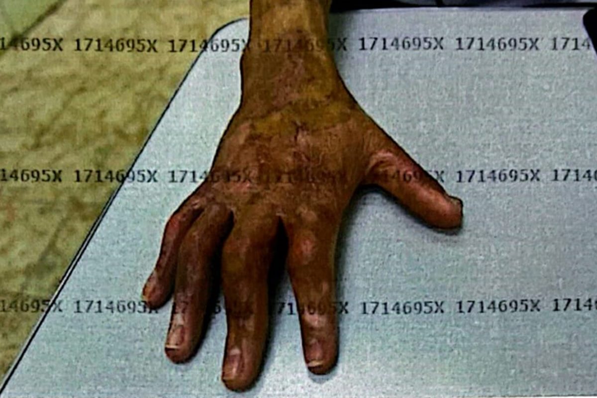 o-desfecho-do-caso-de-eletricista-queimado-ao-levar-choque-no-metro-df