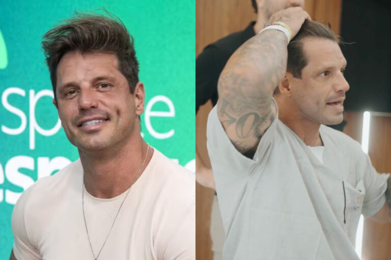 Fotos: Fernando Fernandes passa por transplante capilar