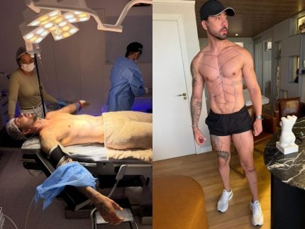 rico-melquiades-realiza-15a-cirurgia-plastica-para-“desenhar”-abdomen-e-pernas