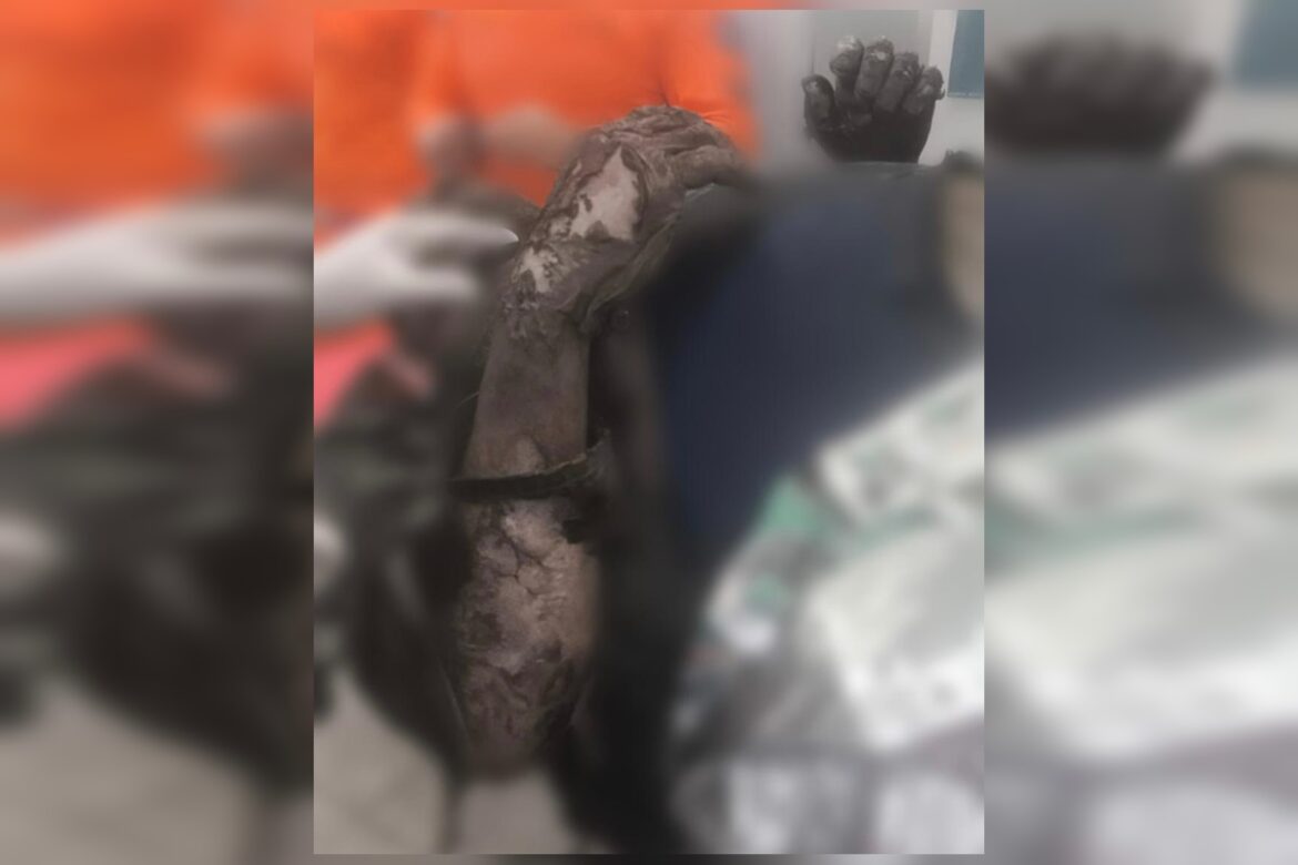 veja-como-trabalhador-queimado-apos-explosao-chegou-a-hospital-no-df