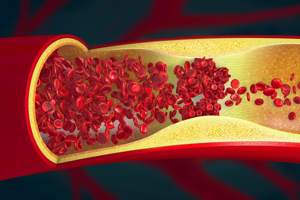 cardiologista-aponta-os-2-piores-habitos-que-“entopem”-as-arterias