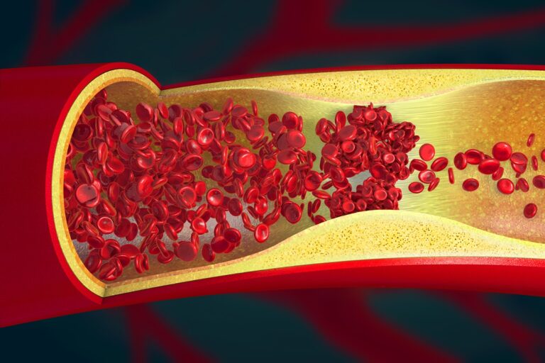 cardiologista-aponta-os-2-piores-habitos-que-“entopem”-as-arterias