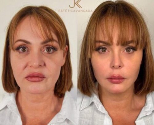 Gaby Spanic surge irreconhecível após seis procedimentos no rosto Gaby Spanic surge irreconhecível após seis procedimentos no rosto