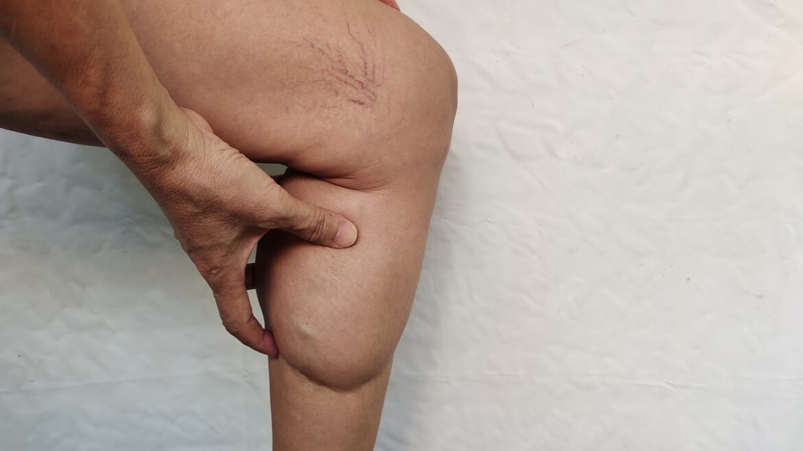 emagrecer-melhora-o-lipedema?-veja-se-a-dieta-atua-contra-a-doenca