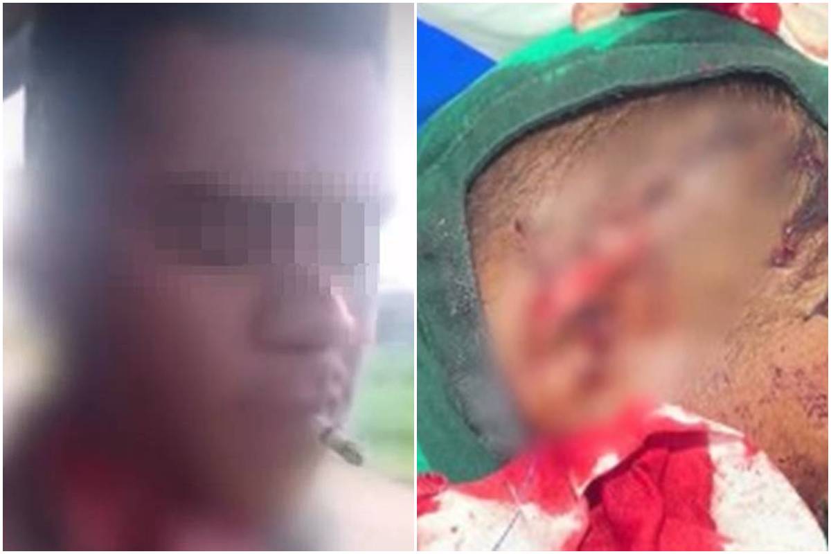 apos-perder-parte-da-orelha-em-briga,-homem-acende-cigarro-no-bar