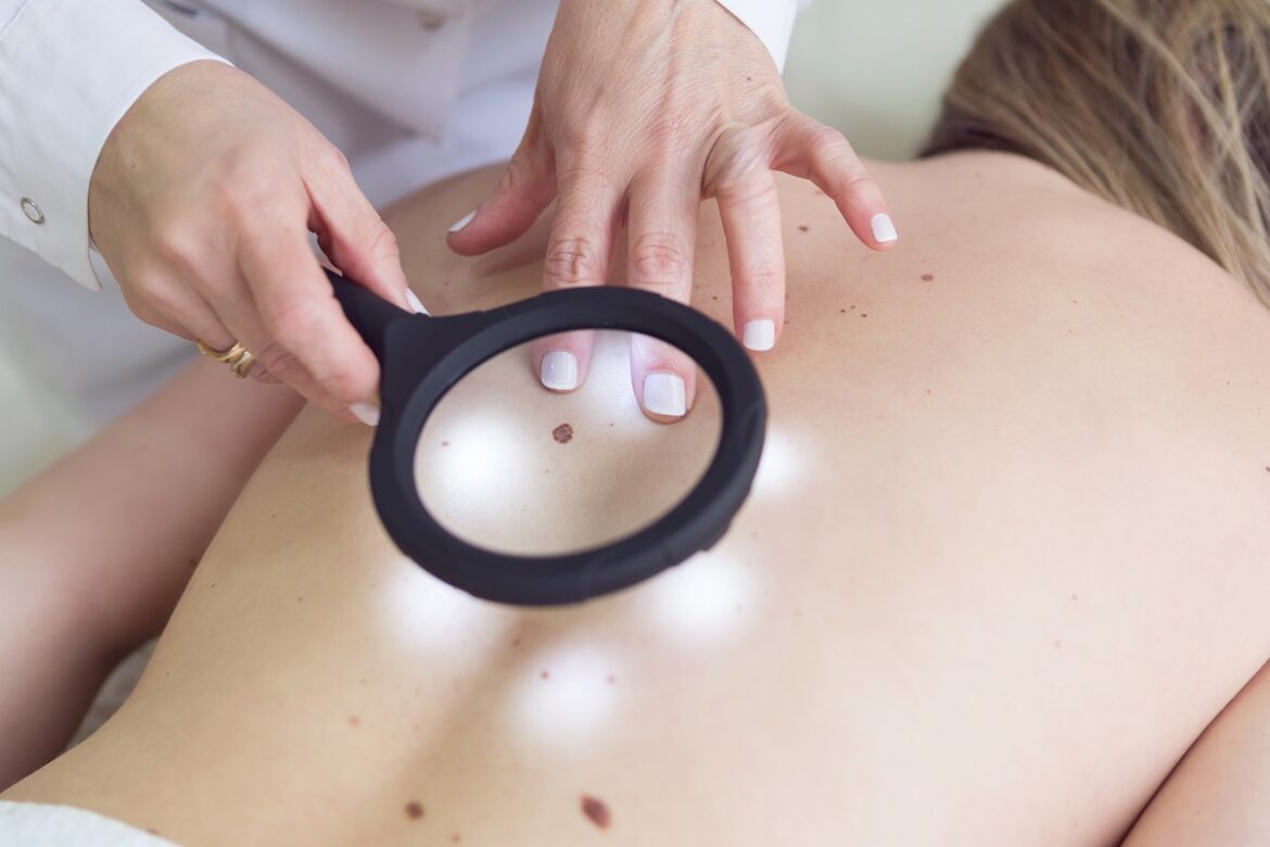 hran-oferece-exame-gratuito-de-cancer-de-pele-neste-sabado-(13/12)