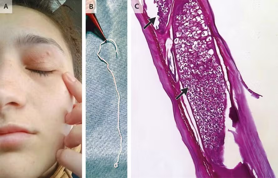 mulher-tem-verme-de-11-cm-removido-da-palpebra