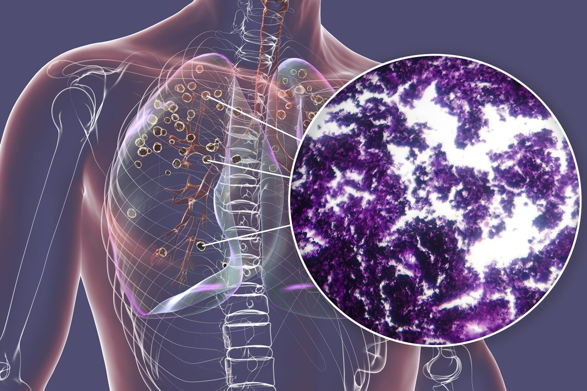 exame-de-sangue-pode-antecipar-diagnostico-do-cancer-de-pulmao