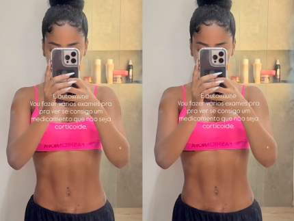 apos-revelar-doenca-autoimune,-lorena-maria-mostra-manchas-na-barriga