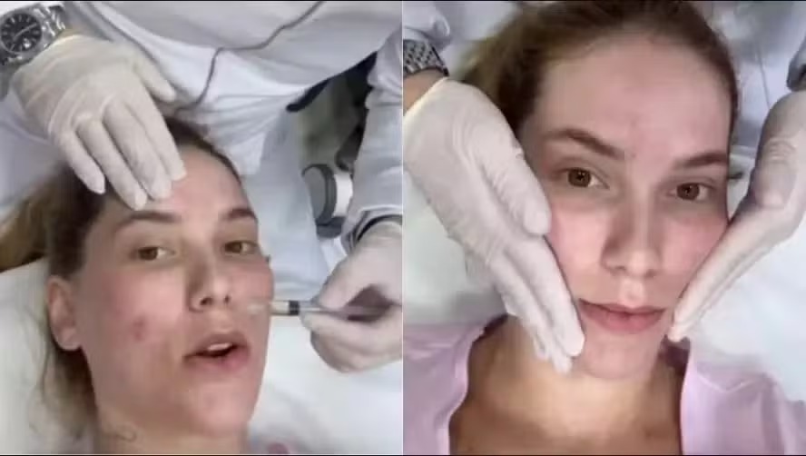 ‘esperma-de-salmao’:-biomedica-explica-o-tratamento-estetico-que-virou-febre-entre-famosos