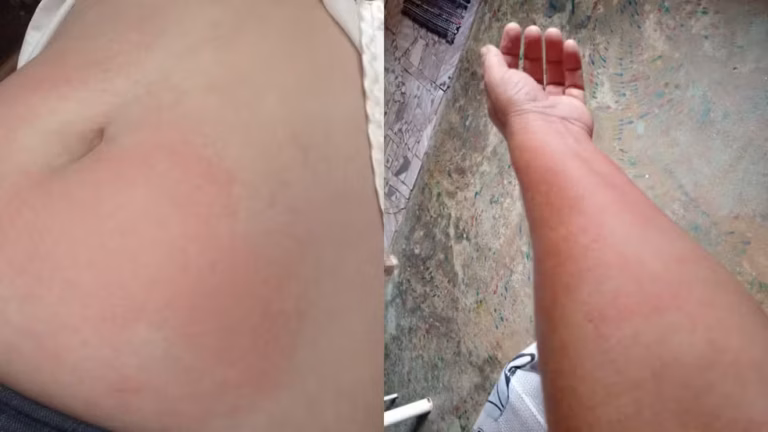 Alergia à água: rondoniense luta contra doença rara que transforma até o suor em risco