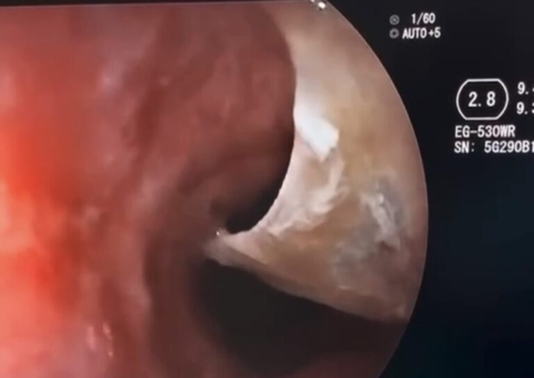 Osso de galinha preso no esôfago leva mulher a emergência em Cruzeiro do Sul