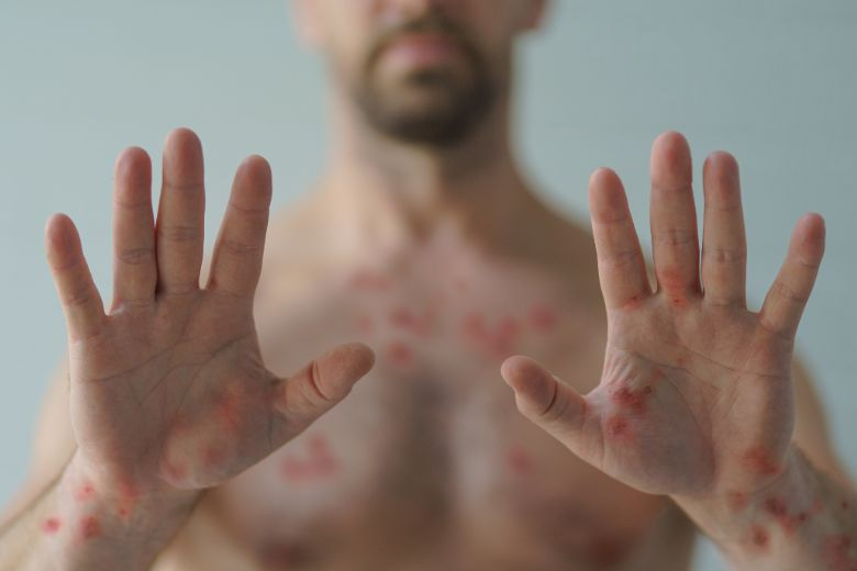 mpox-pode-afetar-fertilidade-masculina,-aponta-estudo