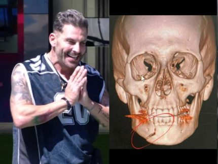 mandibula-fraturada-e-sequelas:-o-drama-de-saude-que-henri-castelli-carrega-ate-hoje