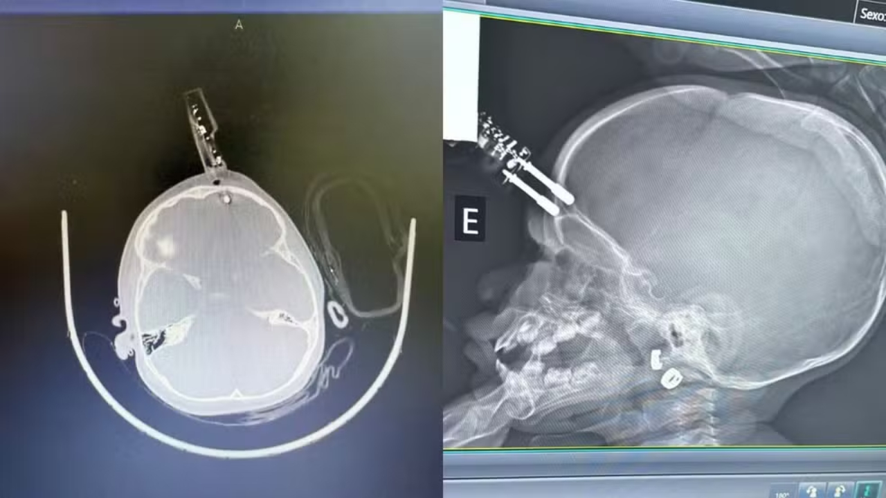 menina-de-1-ano-cai-da-cama-e-tem-carregador-cravado-na-testa