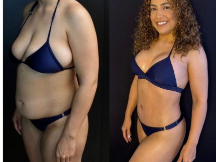 camila-moura-mostra-resultado-das-cirurgias-plasticas-apos-perder-40-kg