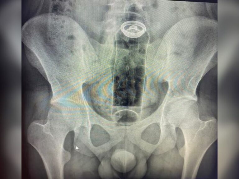 Jovem de 19 anos é internado após desodorante ficar preso no ânus