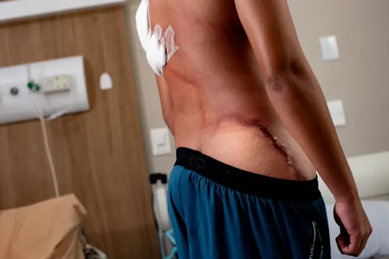 Jovem ferido por raio durante ato político deixa hospital