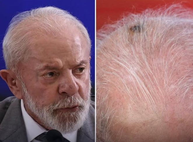lula-aparece-em-cerimonia-com-marca-na-cabeca;-veja-foto