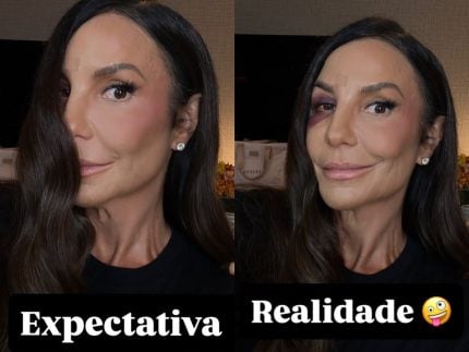 expectativa-x-realidade:-ivete-sangalo-mostra-como-ficou-o-rosto-apos-cair-e-se-machucar